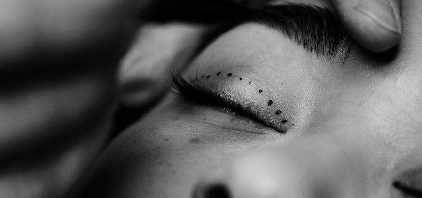 Dr Efraim vd Walt - Blepharoplasty Dr Efraim vd Walt - Blepharoplasty